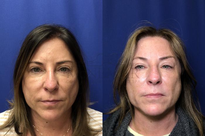 Buccal Fat Removal Case 173 Before & After Front | Tracy, Brentwood & Livermore, CA | McNemar Cosmetic Surgery