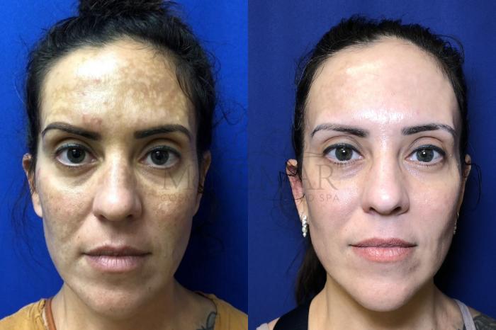 Chemical Peels Case 160 Before & After Front | Tracy, Brentwood & Livermore, CA | McNemar Cosmetic Surgery