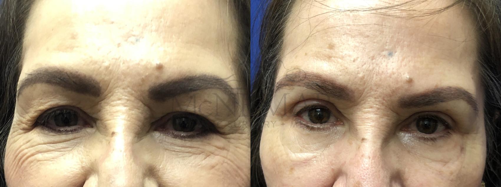 Eyelid Surgery (Blepharoplasty) Case 136 Before & After Front | San Ramon & Tracy, CA | McNemar Cosmetic Surgery