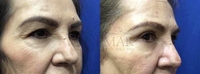 Eyelid Surgery (Blepharoplasty) Case 136 Before & After Left Oblique | Tracy, Brentwood & Livermore, CA | McNemar Cosmetic Surgery