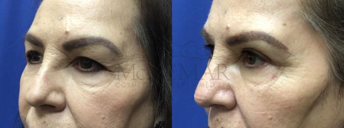 Eyelid Surgery (Blepharoplasty) Case 136 Before & After Right Oblique | Tracy, Brentwood & Livermore, CA | McNemar Cosmetic Surgery