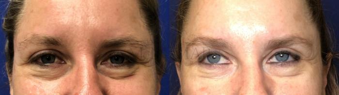 Eyelid Surgery (Blepharoplasty) Case 165 Before & After Front | Tracy, Brentwood & Livermore, CA | McNemar Cosmetic Surgery