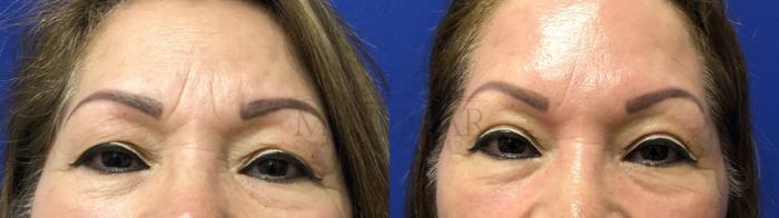 Eyelid Surgery (Blepharoplasty) Case 167 Before & After Front | Tracy, Brentwood & Livermore, CA | McNemar Cosmetic Surgery