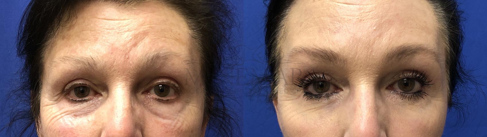 Eyelid Surgery (Blepharoplasty) Case 169 Before & After Front | Tracy, Brentwood & Livermore, CA | McNemar Cosmetic Surgery