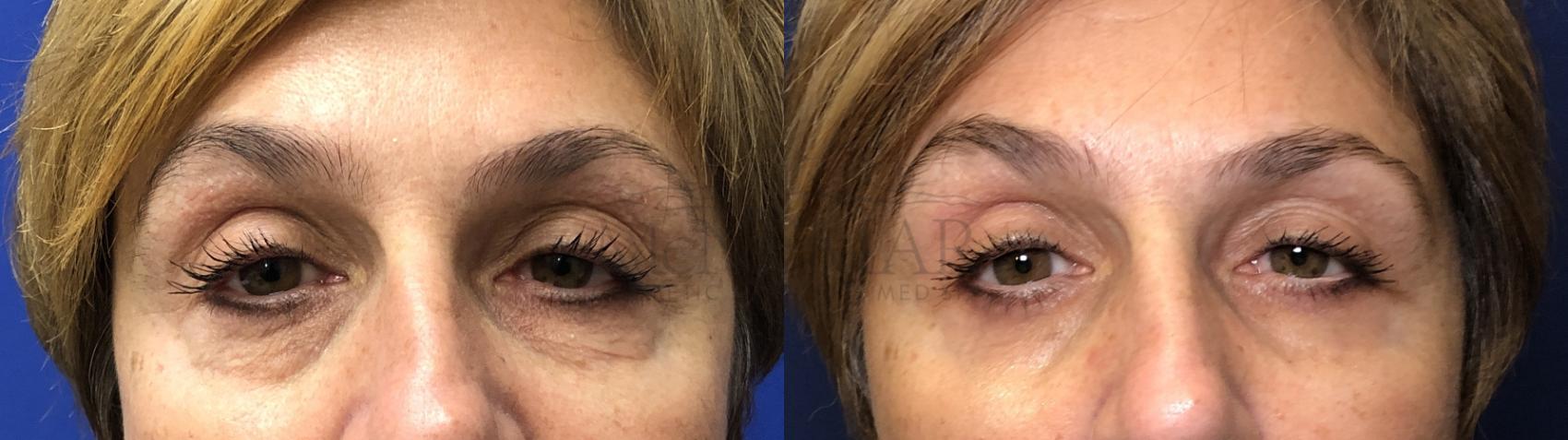 Eyelid Surgery (Blepharoplasty) Case 170 Before & After Front | Tracy, Brentwood & Livermore, CA | McNemar Cosmetic Surgery