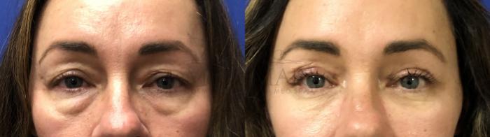 Eyelid Surgery (Blepharoplasty) Case 172 Before & After Front | Tracy, Brentwood & Livermore, CA | McNemar Cosmetic Surgery