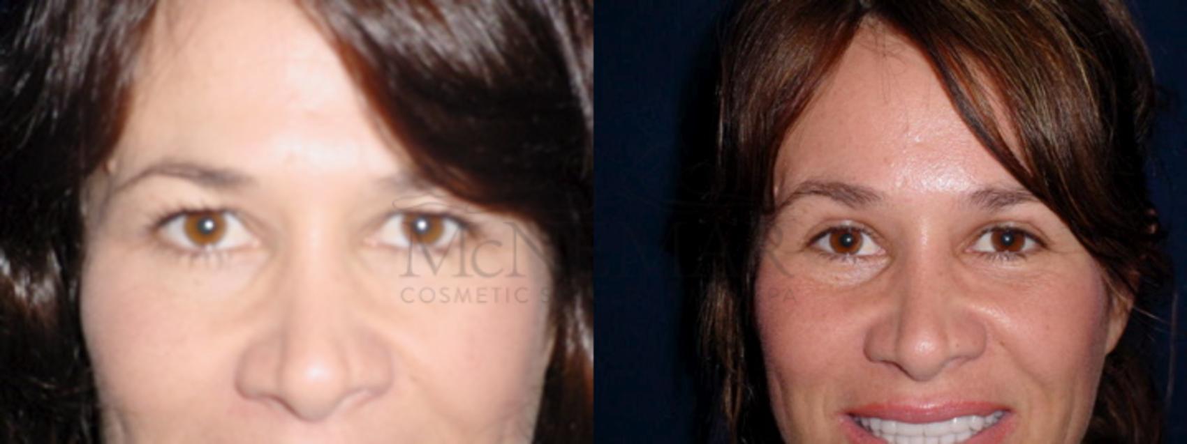 Eyelid Surgery (Blepharoplasty) Case 50 Before & After View #1 | San Ramon & Tracy, CA | McNemar Cosmetic Surgery