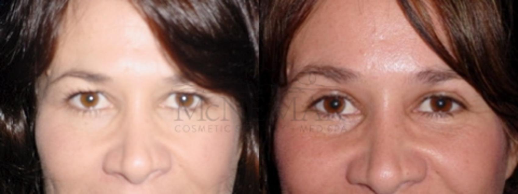 Eyelid Surgery (Blepharoplasty) Case 50 Before & After View #1 | Tracy, Brentwood & Livermore, CA | McNemar Cosmetic Surgery