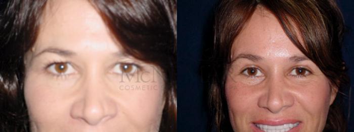 Eyelid Surgery (Blepharoplasty) Case 50 Before & After View #1 | Tracy, Brentwood & Livermore, CA | McNemar Cosmetic Surgery