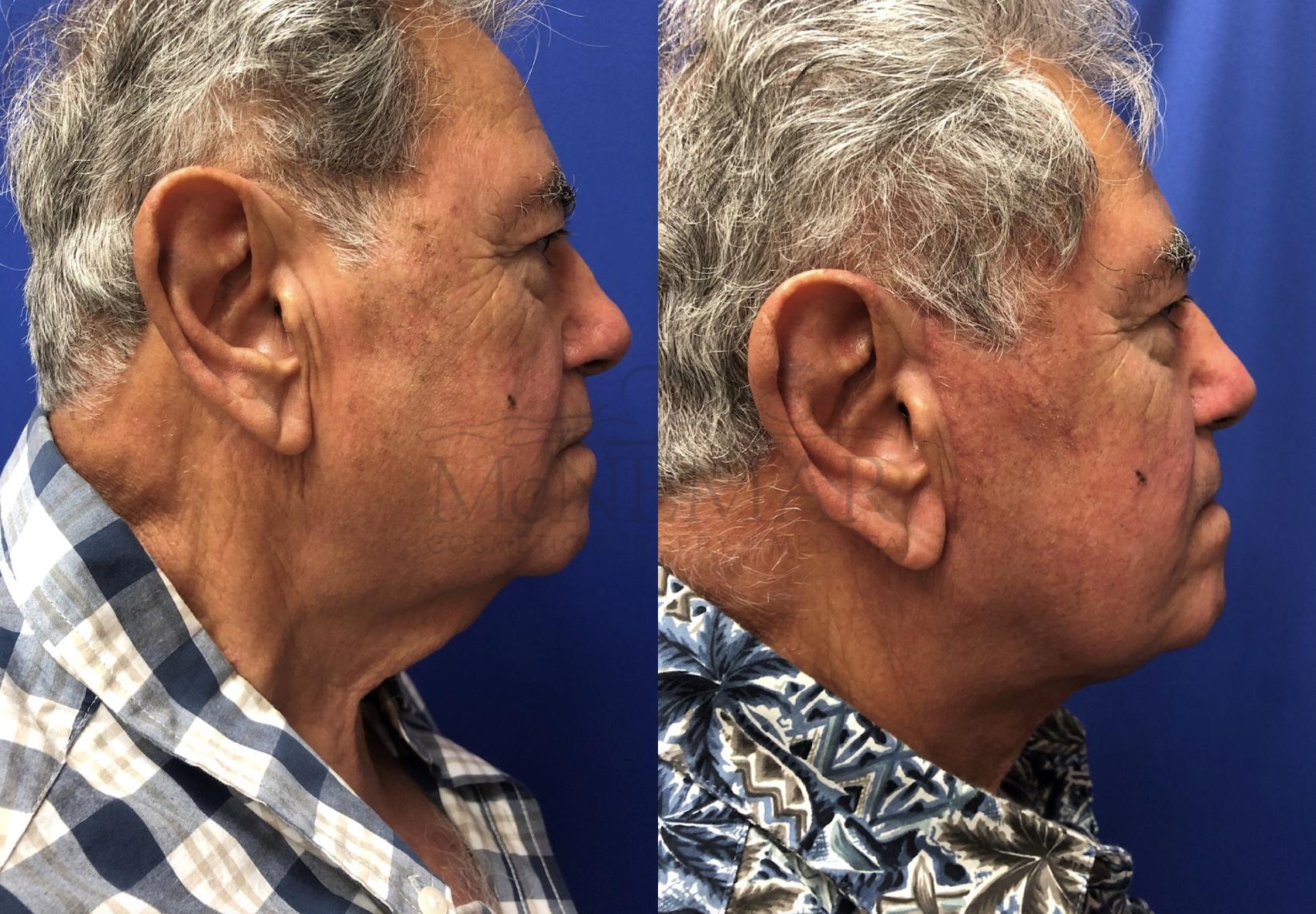 Facelift Case 115 Before & After Right Side | San Ramon & Tracy, CA | McNemar Cosmetic Surgery