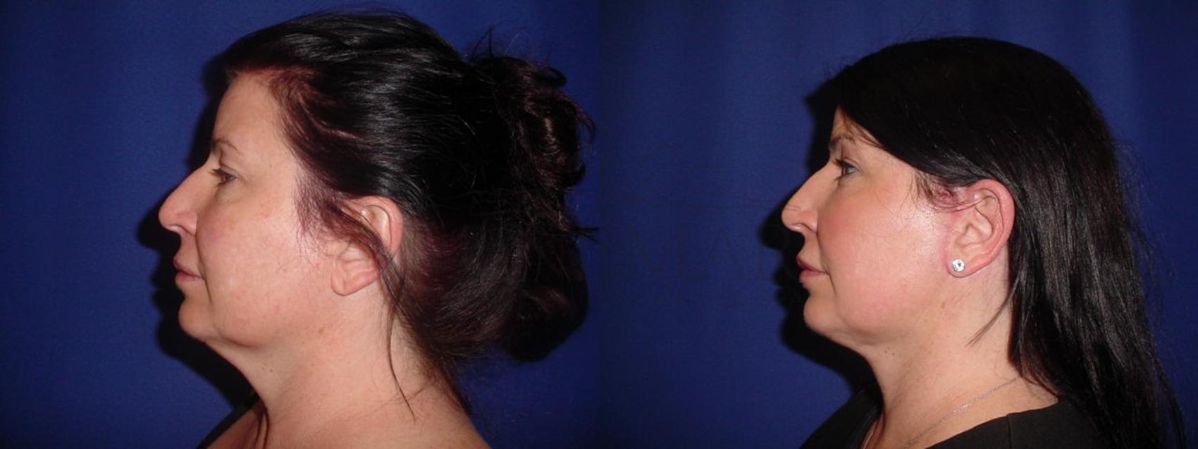 Facelift Case 117 Before & After Left Side | San Ramon & Tracy, CA | McNemar Cosmetic Surgery