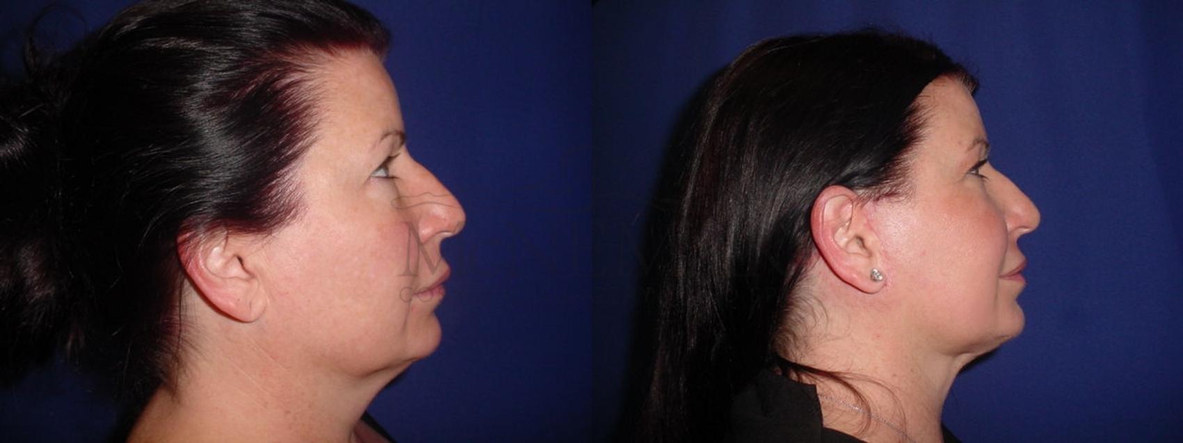 Facelift Case 117 Before & After Right Side | San Ramon & Tracy, CA | McNemar Cosmetic Surgery