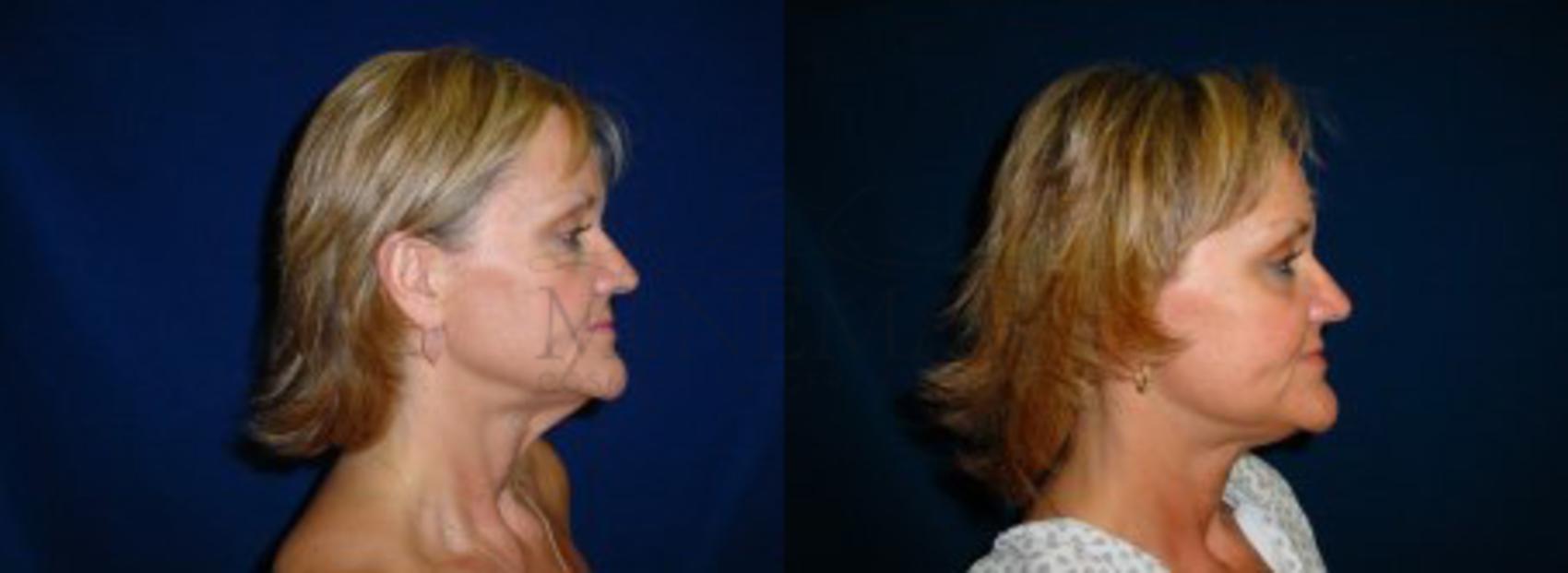 Facelift Case 12 Before & After View #2 | San Ramon & Tracy, CA | McNemar Cosmetic Surgery