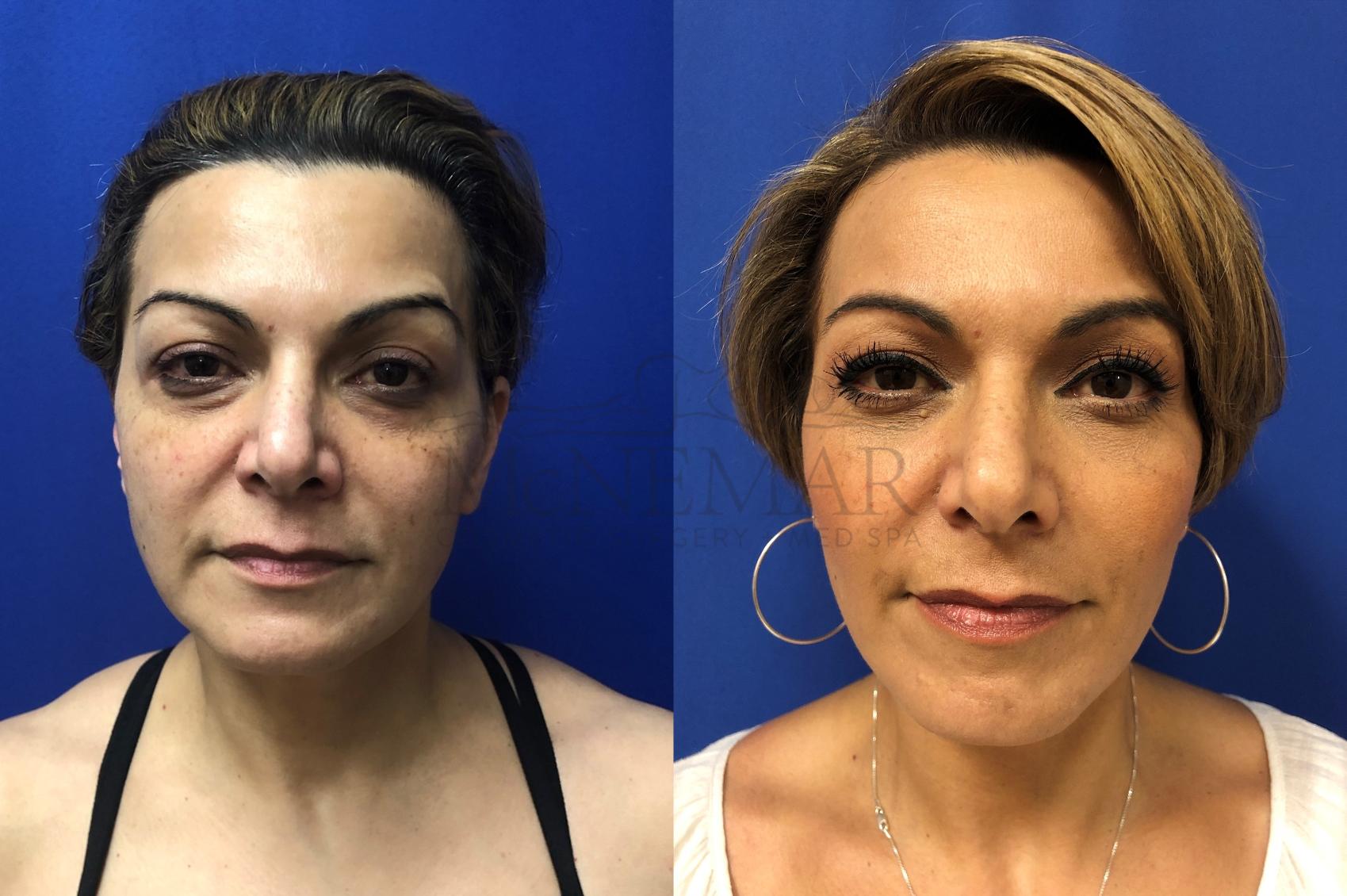 Facelift for a 50 year old female patient.