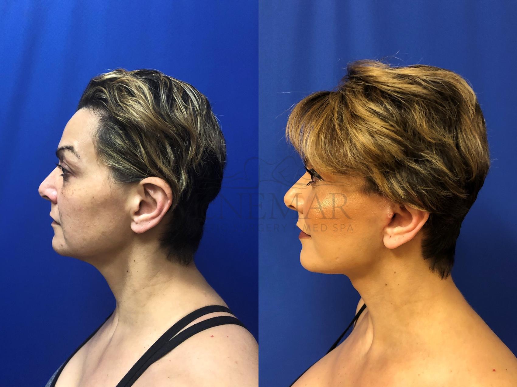 Facelift for a 50 year old female patient.