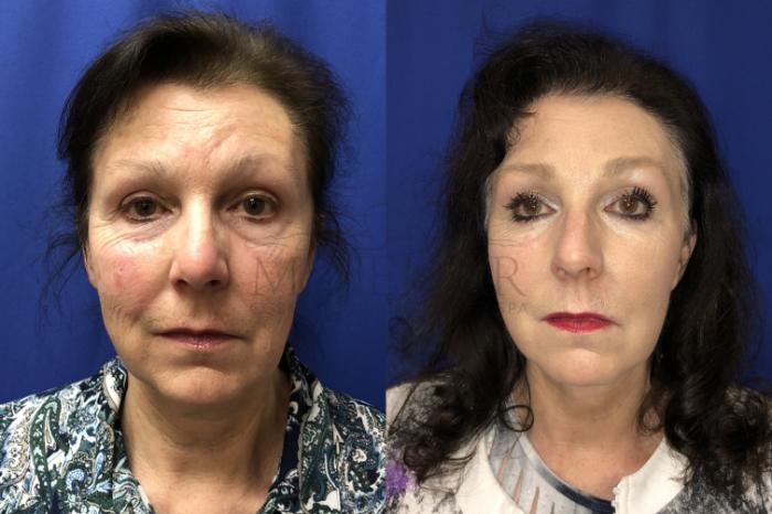 Facelift Case 132 Before & After Front | San Ramon & Tracy, CA | McNemar Cosmetic Surgery