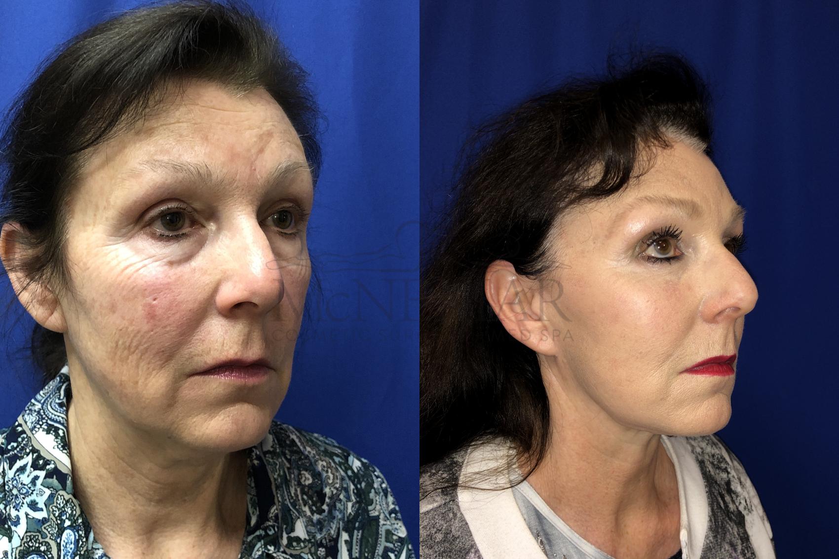 Facelift Case 132 Before & After Left Oblique | San Ramon & Tracy, CA | McNemar Cosmetic Surgery
