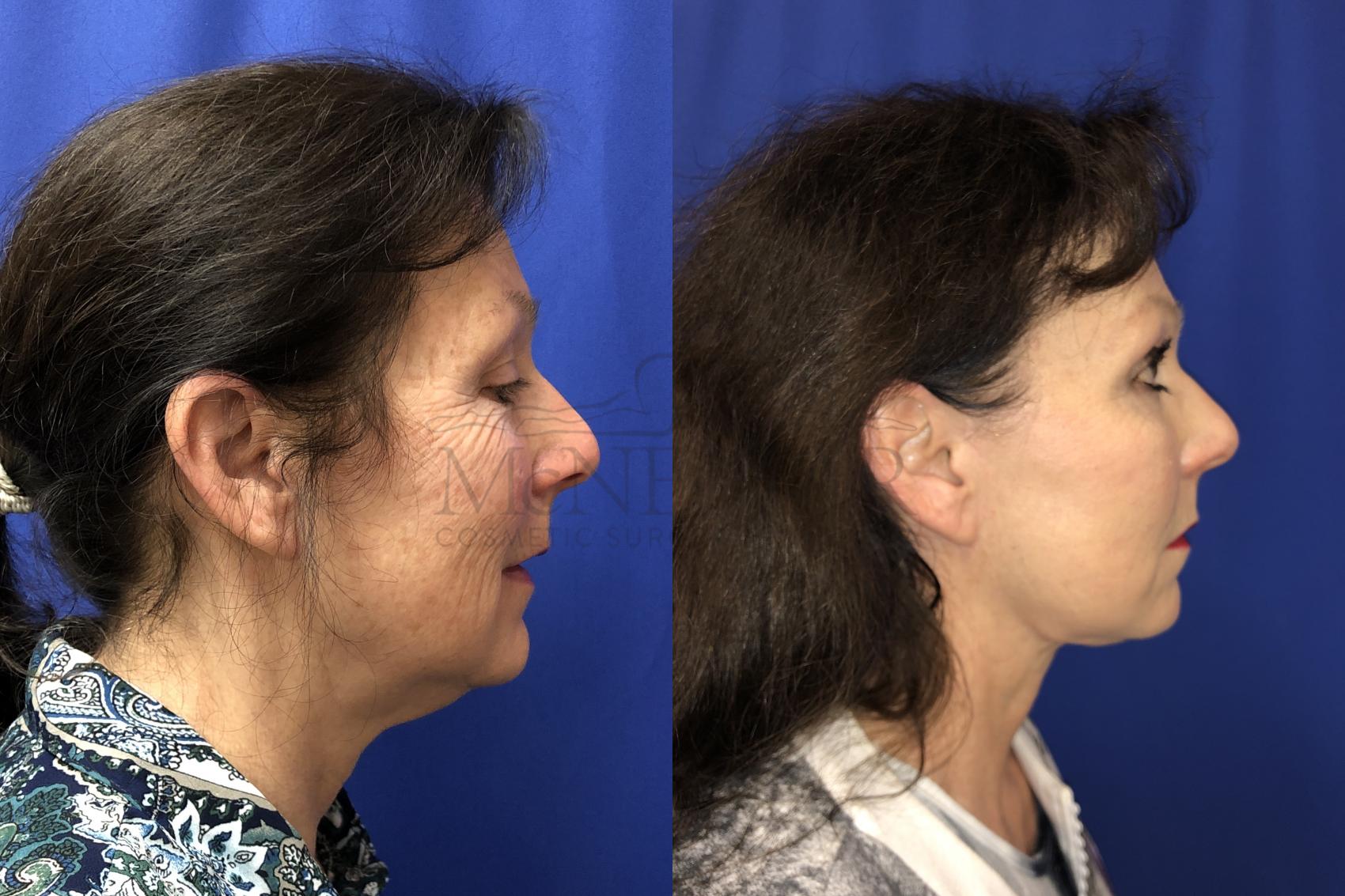Facelift Case 132 Before & After Left Side | San Ramon & Tracy, CA | McNemar Cosmetic Surgery