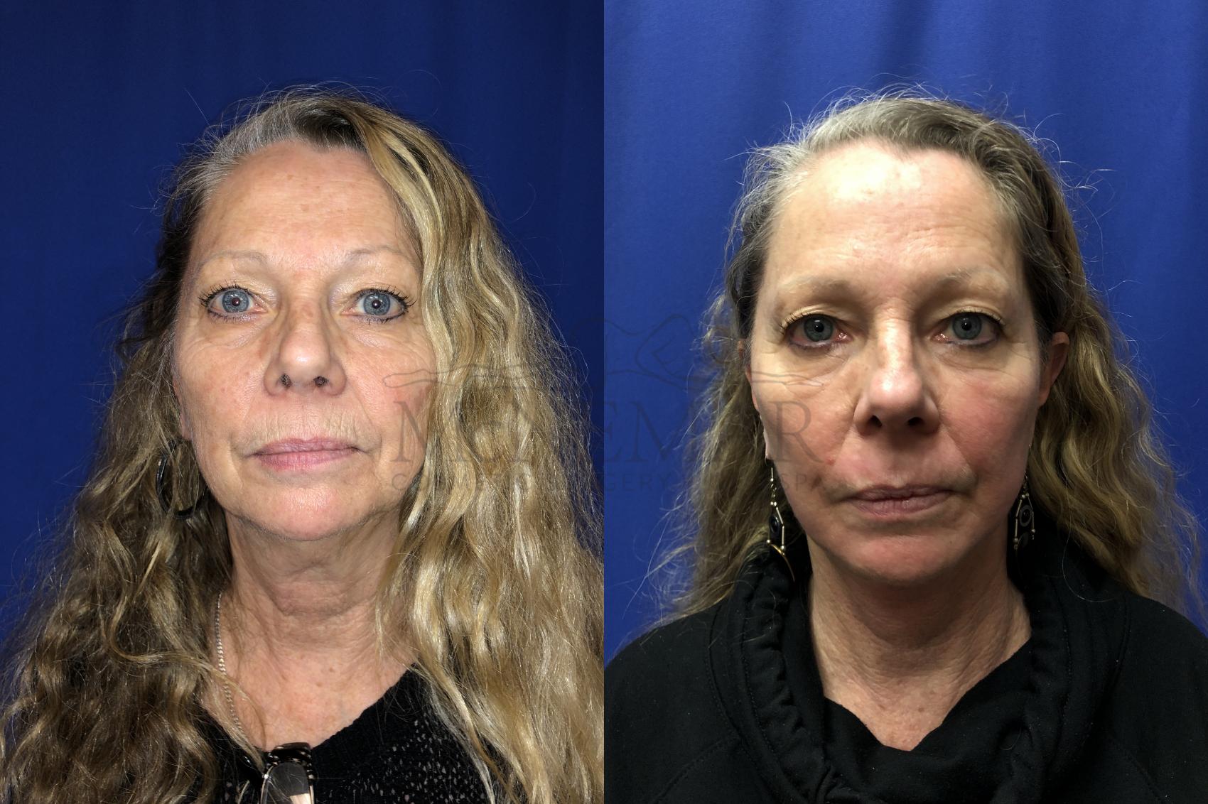 Facelift Case 134 Before & After Front | San Ramon & Tracy, CA | McNemar Cosmetic Surgery