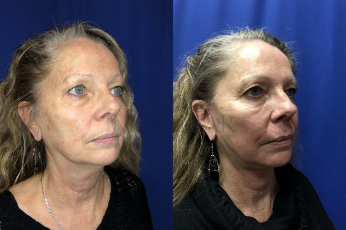 Facelift Case 134 Before & After Left Oblique | San Ramon & Tracy, CA | McNemar Cosmetic Surgery