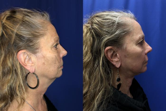 Facelift Case 134 Before & After Left Side | San Ramon & Tracy, CA | McNemar Cosmetic Surgery