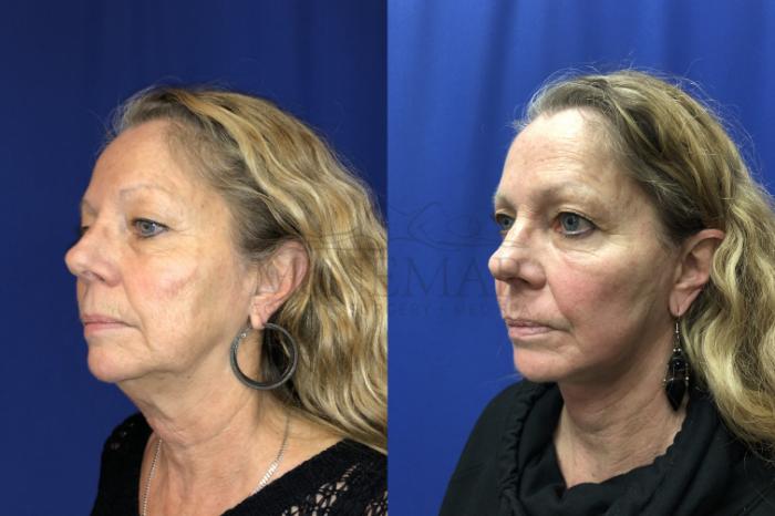 Facelift Case 134 Before & After Right Oblique | San Ramon & Tracy, CA | McNemar Cosmetic Surgery