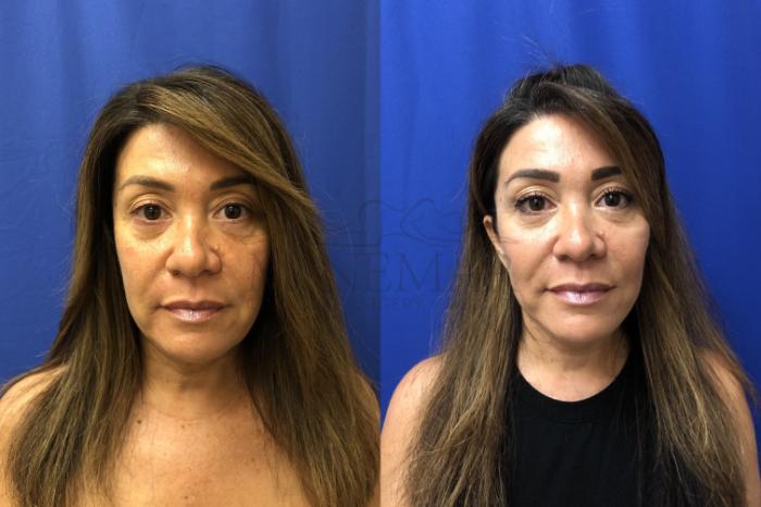 Facelift Case 147 Before & After Front | San Ramon & Tracy, CA | McNemar Cosmetic Surgery