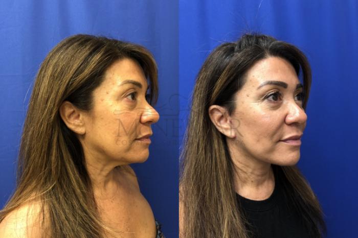 Facelift Case 147 Before & After Left Side | San Ramon & Tracy, CA | McNemar Cosmetic Surgery