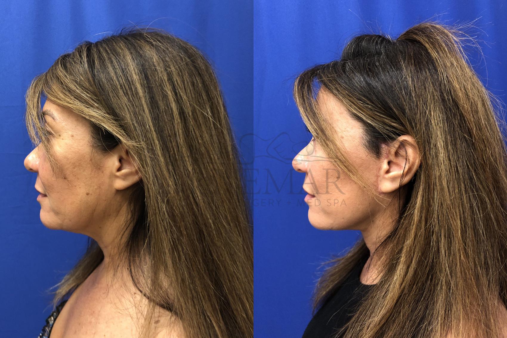 Facelift Case 147 Before & After Right Oblique | San Ramon & Tracy, CA | McNemar Cosmetic Surgery