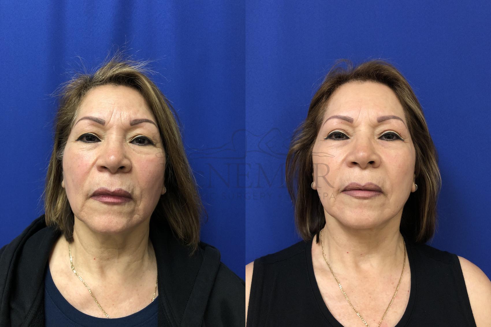 Facelift Case 151 Before & After Front | Tracy, Brentwood & Livermore, CA | McNemar Cosmetic Surgery