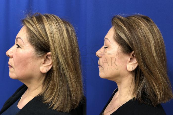Facelift Case 151 Before & After Right Side | Tracy, Brentwood & Livermore, CA | McNemar Cosmetic Surgery
