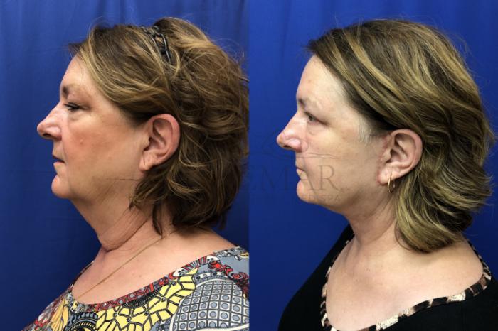 Facelift Case 153 Before & After Right Oblique | San Ramon & Tracy, CA | McNemar Cosmetic Surgery