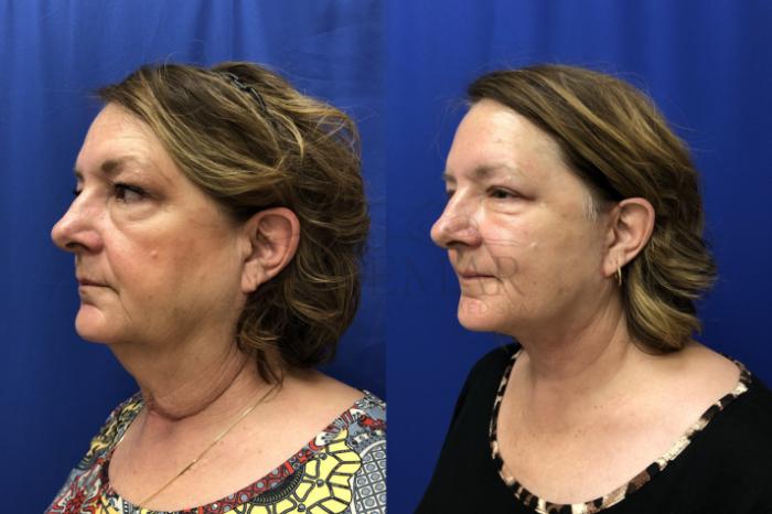 Facelift Case 153 Before & After Right Side | Tracy, Brentwood & Livermore, CA | McNemar Cosmetic Surgery