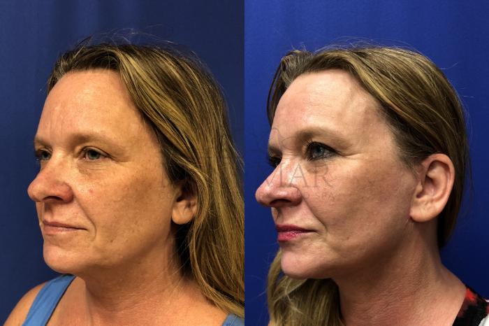 Facelift Case 161 Before & After Right Oblique | Tracy, Brentwood & Livermore, CA | McNemar Cosmetic Surgery