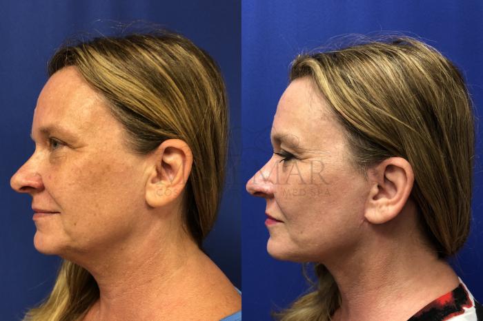 Facelift Case 161 Before & After Right Side | Tracy, Brentwood & Livermore, CA | McNemar Cosmetic Surgery
