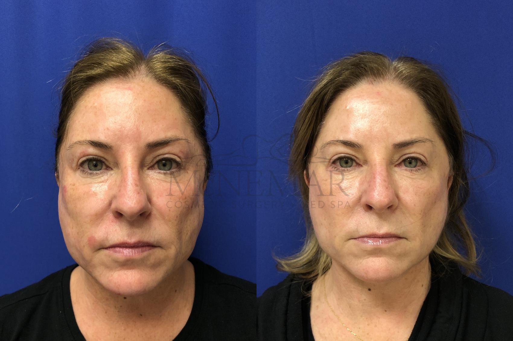 Facelift Case 162 Before & After Front | Tracy, Brentwood & Livermore, CA | McNemar Cosmetic Surgery