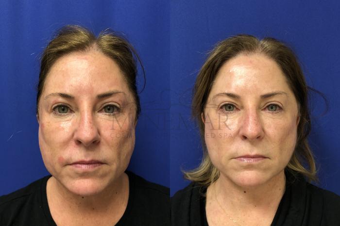 Facelift Case 162 Before & After Front | Tracy, Brentwood & Livermore, CA | McNemar Cosmetic Surgery