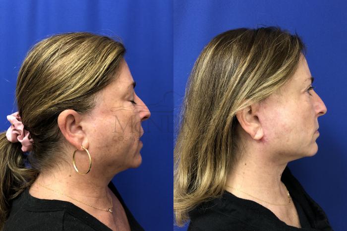 Facelift Case 162 Before & After Right Side | Tracy, Brentwood & Livermore, CA | McNemar Cosmetic Surgery