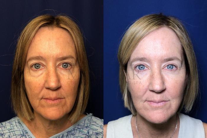 Facelift Case 163 Before & After Front | Tracy, Brentwood & Livermore, CA | McNemar Cosmetic Surgery