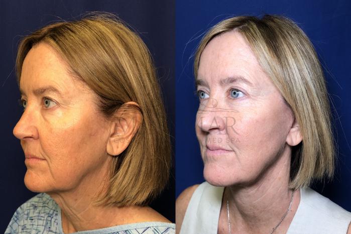 Facelift Case 163 Before & After Left Side | Tracy, Brentwood & Livermore, CA | McNemar Cosmetic Surgery