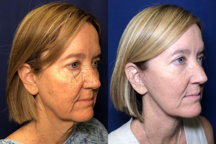 Facelift Case 163 Before & After Right Oblique | Tracy, Brentwood & Livermore, CA | McNemar Cosmetic Surgery