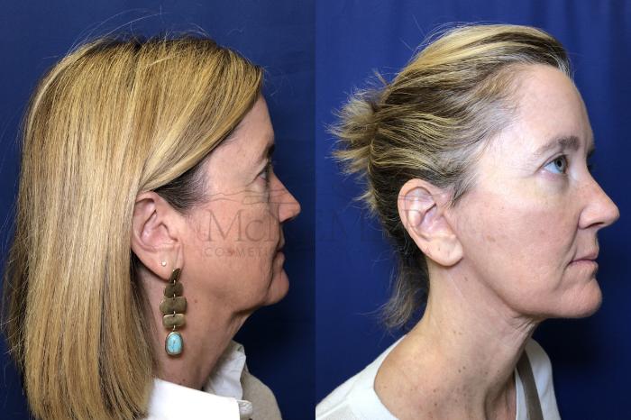 Facelift Case 163 Before & After Right Side | Tracy, Brentwood & Livermore, CA | McNemar Cosmetic Surgery