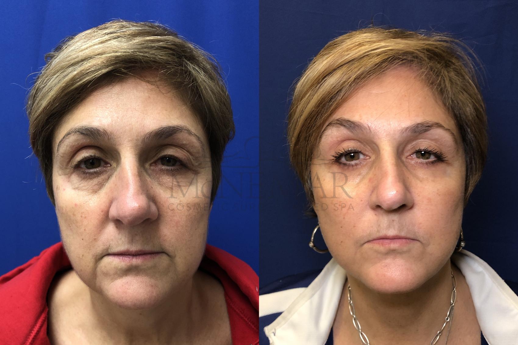 Facelift Case 164 Before & After Front | Tracy, Brentwood & Livermore, CA | McNemar Cosmetic Surgery