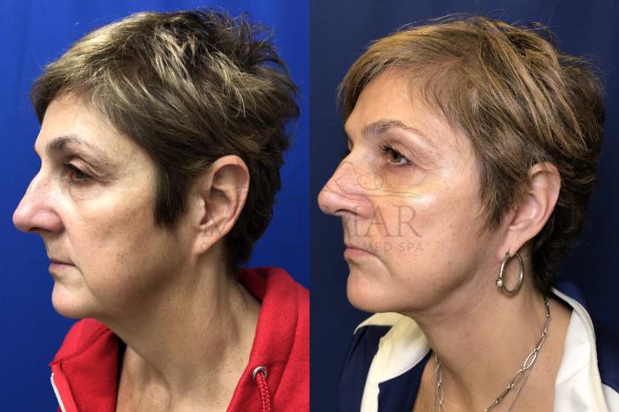 Facelift Case 164 Before & After Left Side | Tracy, Brentwood & Livermore, CA | McNemar Cosmetic Surgery