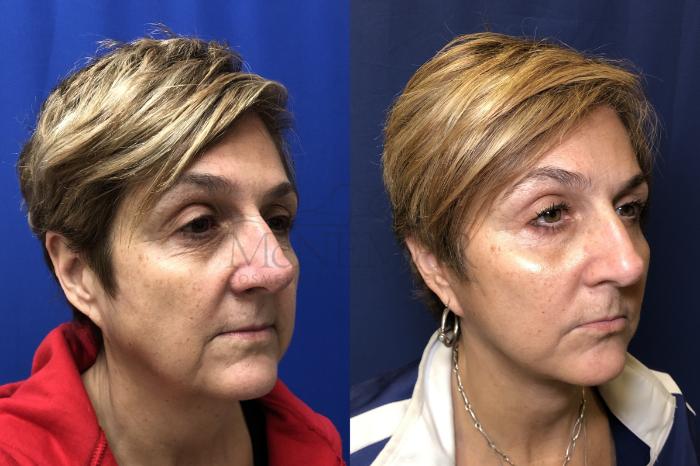 Facelift Case 164 Before & After Right Oblique | Tracy, Brentwood & Livermore, CA | McNemar Cosmetic Surgery