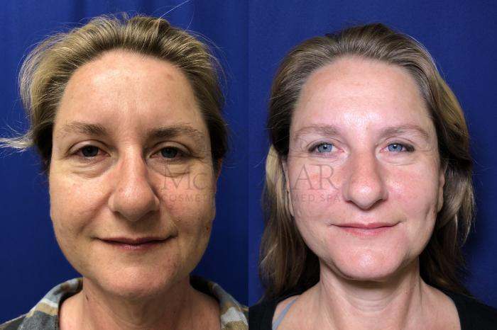 Facelift Case 166 Before & After Front | Tracy, Brentwood & Livermore, CA | McNemar Cosmetic Surgery