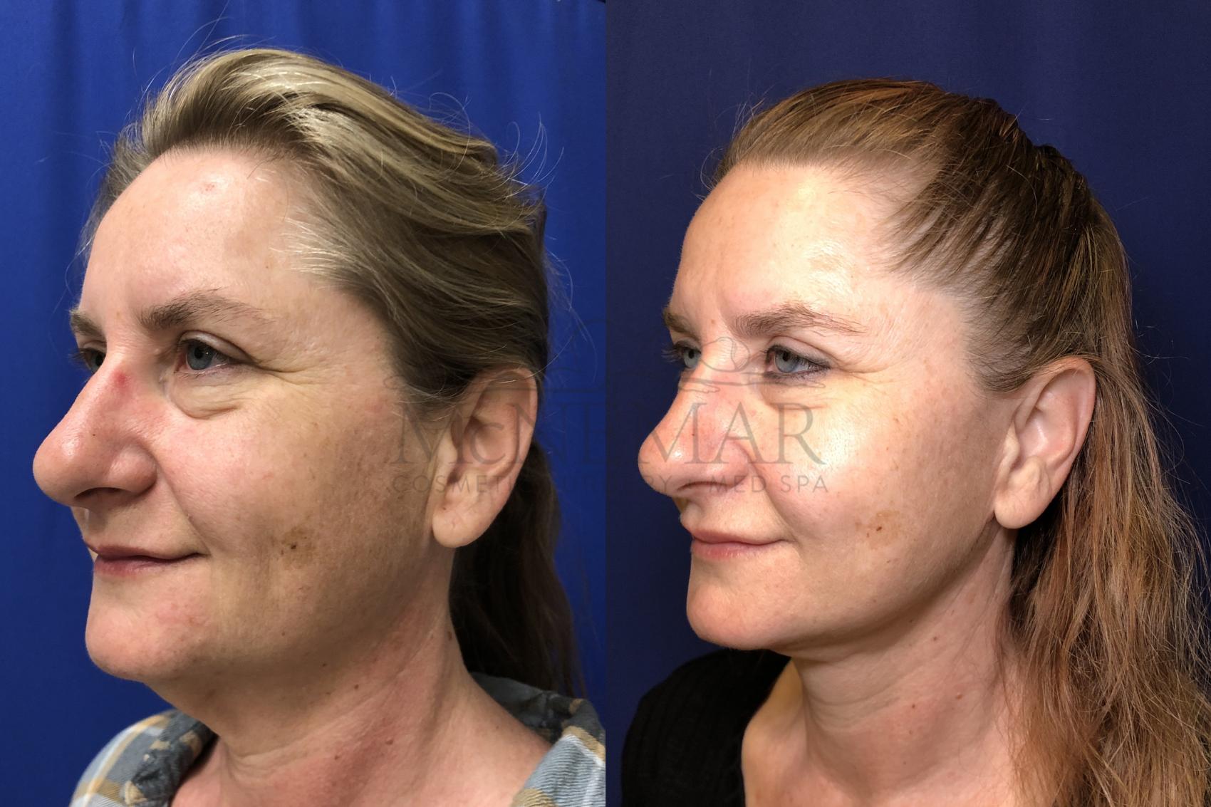 Facelift Case 166 Before & After Left Oblique | Tracy, Brentwood & Livermore, CA | McNemar Cosmetic Surgery