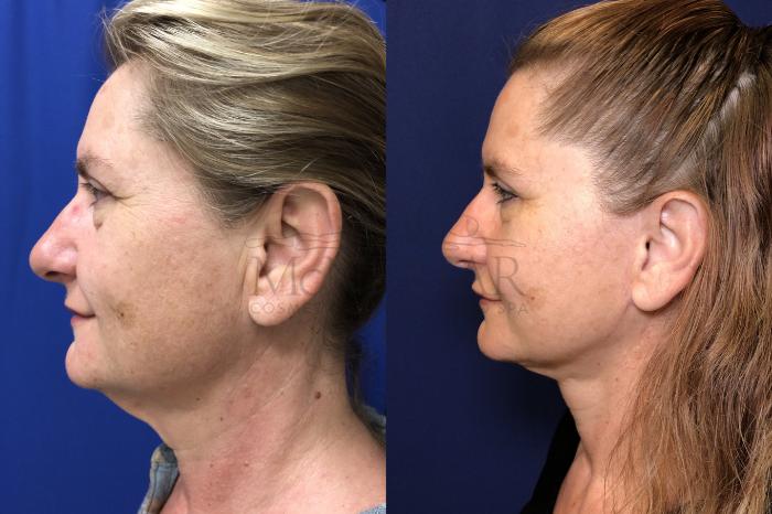 Facelift Case 166 Before & After Left Side | Tracy, Brentwood & Livermore, CA | McNemar Cosmetic Surgery