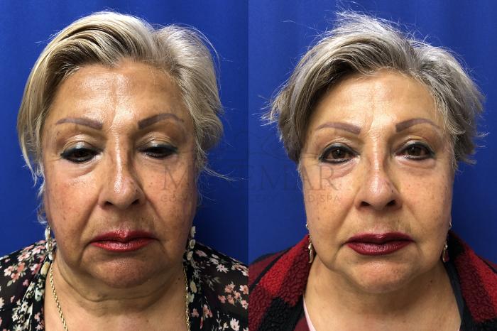 Facelift Case 171 Before & After Front | Tracy, Brentwood & Livermore, CA | McNemar Cosmetic Surgery