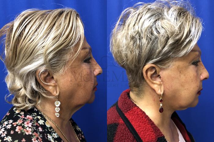 Facelift Case 171 Before & After Right Side | Tracy, Brentwood & Livermore, CA | McNemar Cosmetic Surgery
